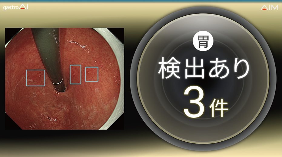 画像上早期胃がん及び腺腫を疑う領域が検出された写真